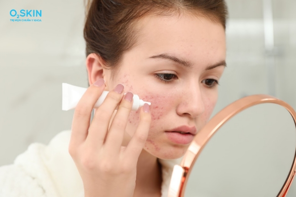 Vì sao peel da bị nổi mụn nước