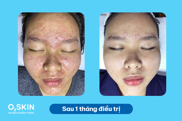 Tình trạng da sau 1 tháng điều trị