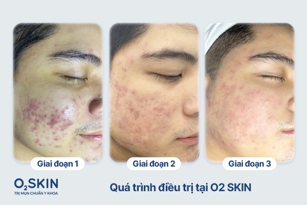 Quá trình điều trị của Tú tại O2 SKIN