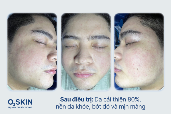 Da của Tú sau điều trị