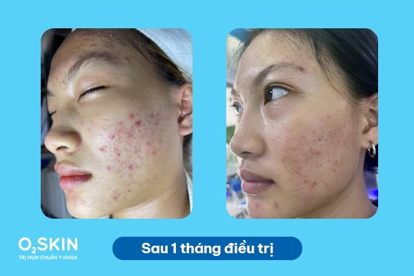 Da của Hậu sau 1 tháng điều trị