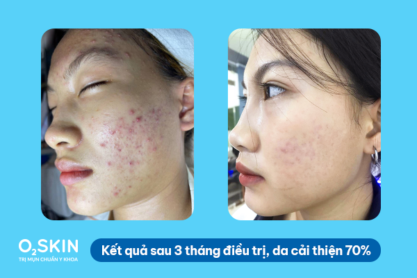 Da của Hậu sau 3 tháng điều trị
