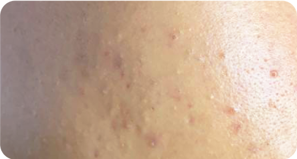 Mụn ẩn/ Mụn cám liti