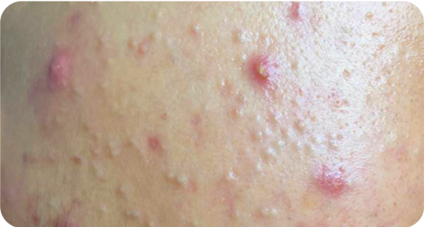 Mụn đầu đen/ Mụn đầu trắng