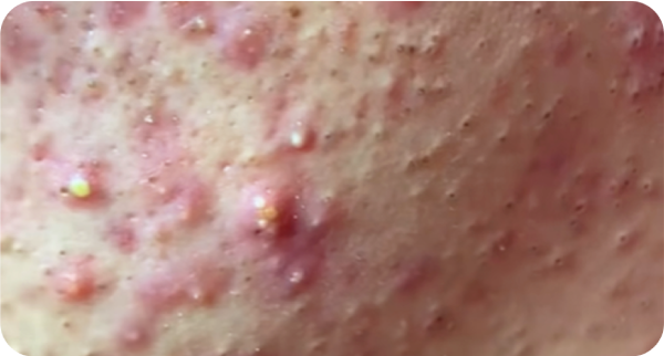 Mụn viêm đã chín, gom cồi