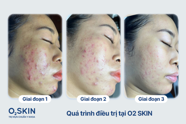 Quá trình điều trị của Thanh Thảo tại O2 SKIN
