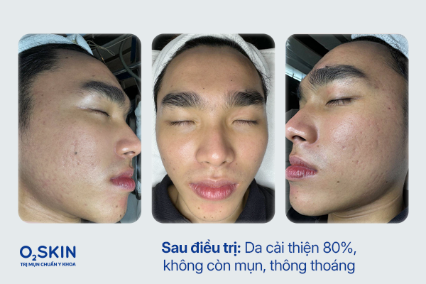 Làn da Thành Long sau điều trị tại O2 SKIN