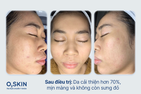 Làn da của Thanh Thảo sau điều trị