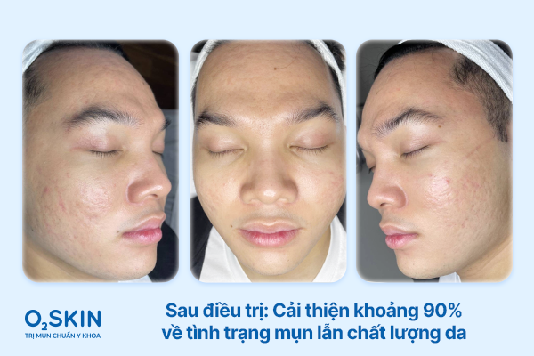 Làn da của Thành Đạt sau khi điều trị