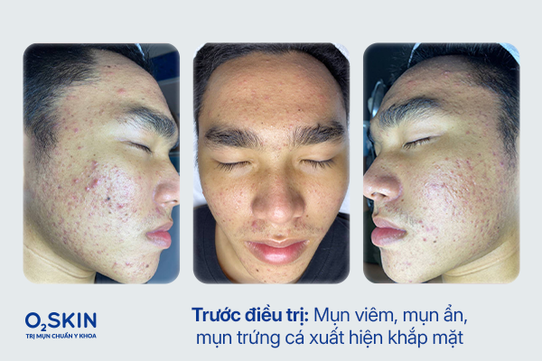 Da của Thành Long trước điều trị: Mụn viêm, mụn ẩn, mụn trứng cá xuất hiện khắp mặt.