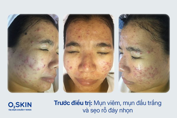 Da của Kim Yến trước điều trị