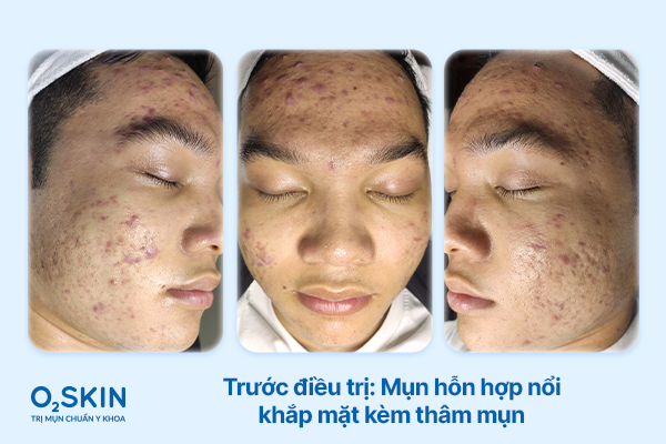 Tình trạng da của Thành Đạt trước khi điều trị