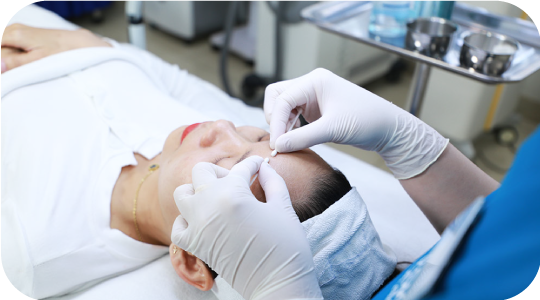 Bước 5: Tiến hành lấy nhân mụn bằng tăm bông Y khoa