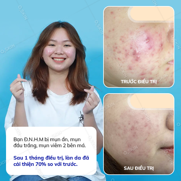 Kết quả trị mụn của khách hàng Đinh Nguyễn Hà My tại phòng khám da liễu O2 SKIN