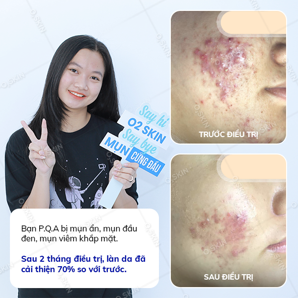 Kết quả trị mụn của khách hàng Phan Quỳnh Anh tại phòng khám da liễu O2 SKIN