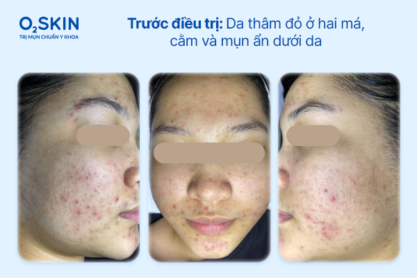 Trước điều trị: Da nhiều thâm đỏ ở hai má và cằm