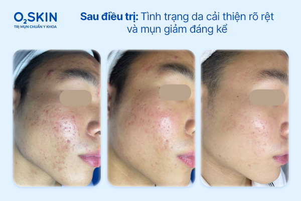 So sánh da qua các mốc 1 – 6 – 12 tuần So sánh da qua các mốc 1 – 6 – 12 tuần