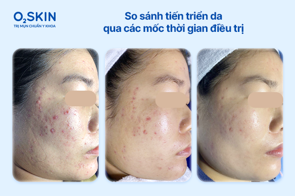 So sánh tiến triển da qua các mốc thời gian điều trị