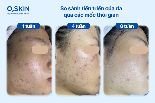 So sánh diễn tiến da qua các mốc thời gian: 1 - 4 - 8 tuần