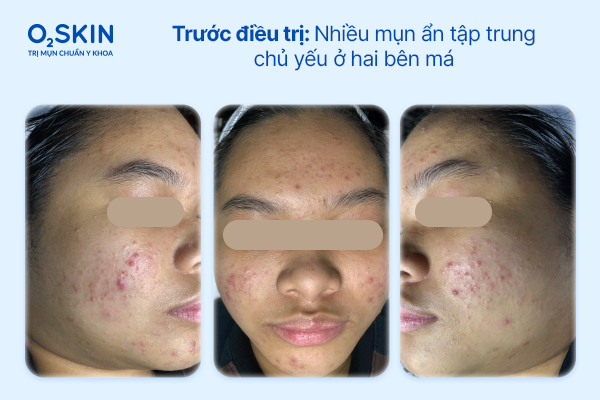 Trước điều trị: Nhiều mụn ẩn tập trung chủ yếu ở hai bên má