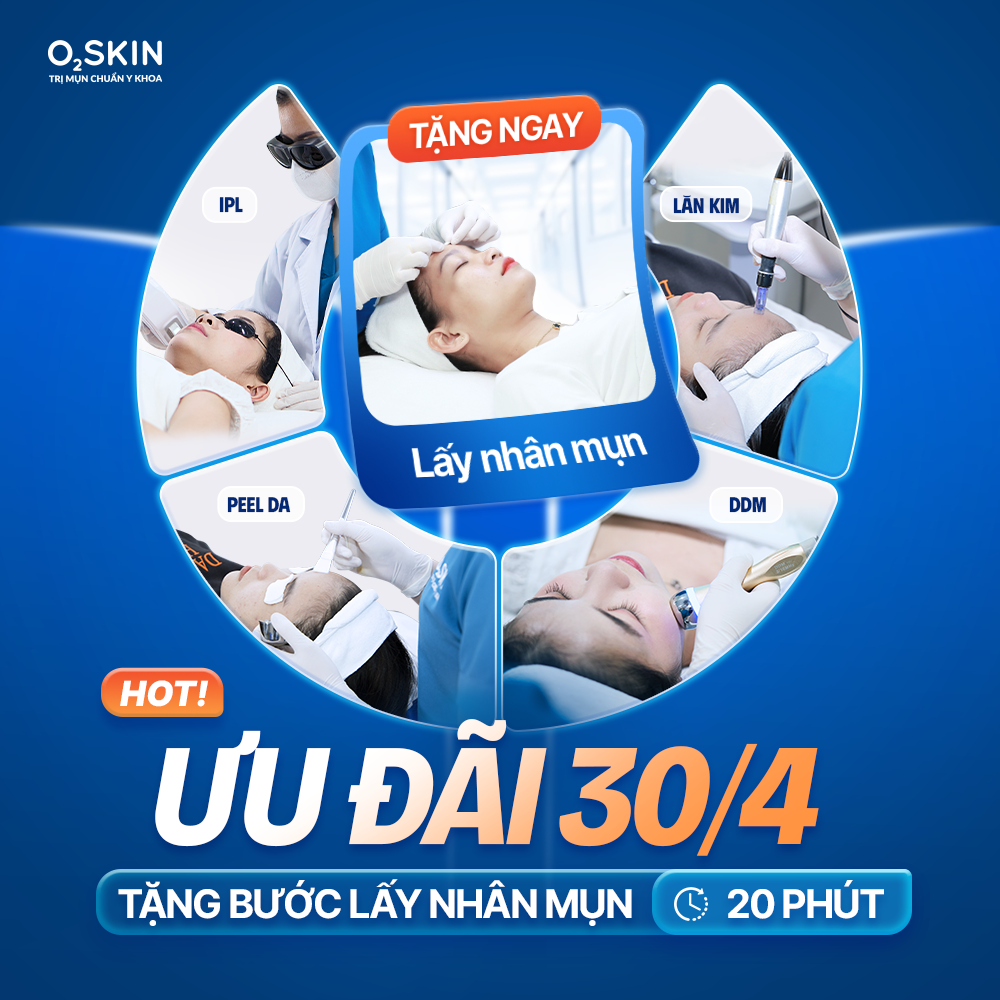 Hot Ưu Đãi 30/4 Tặng Lấy Nhân Mụn