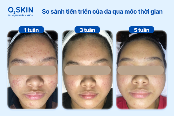 So sánh tiến triển của da qua mốc thời gian: 1 - 3 - 5 tuần