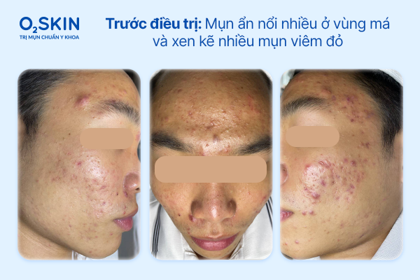 Hình ảnh soi da ghi nhận lỗ chân lông giãn rộng và bã nhờn tích tụ Hình ảnh soi da ghi nhận lỗ chân lông giãn rộng và bã nhờn tích tụ