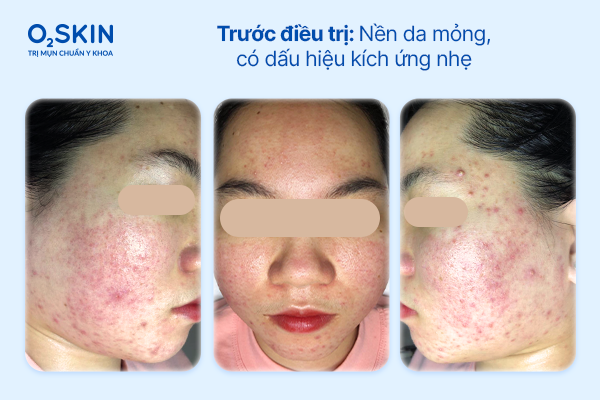 Hình ảnh soi da ghi nhận nền da mỏng, có dấu hiệu kích ứng nhẹ