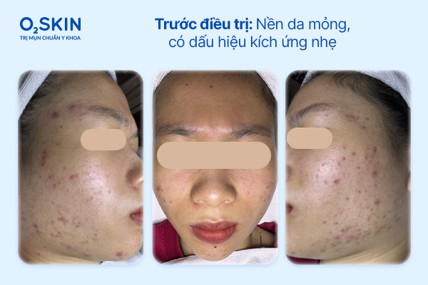 Hình ảnh soi da vùng má ghi nhận nhiều nhân mụn ẩn