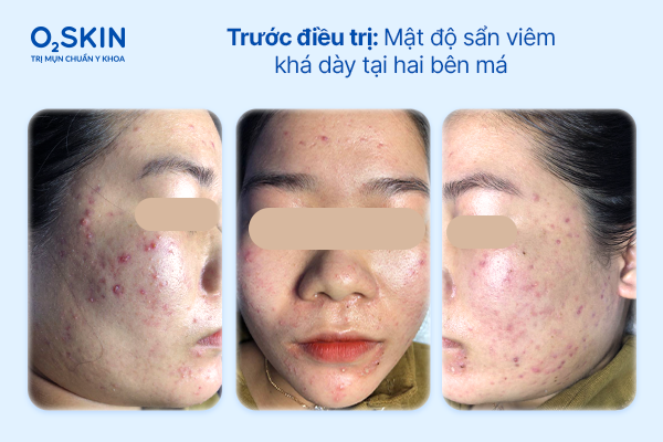 Hình ảnh soi da vùng má ghi nhận nhiều sẩn viêm