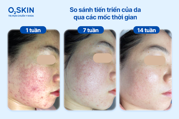 So sánh tiến triển của da qua các mốc thời gian: 1 - 7 - 14 tuần