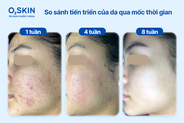 So sánh tiến triển của da qua các mốc thời gian: 1 - 4 - 8 tuần