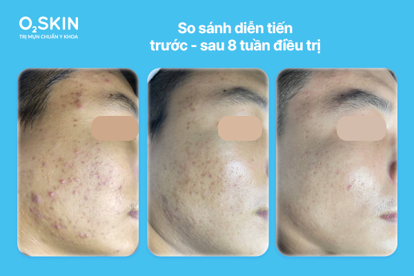 So sánh diễn tiến trước – sau 8 tuần điều trị