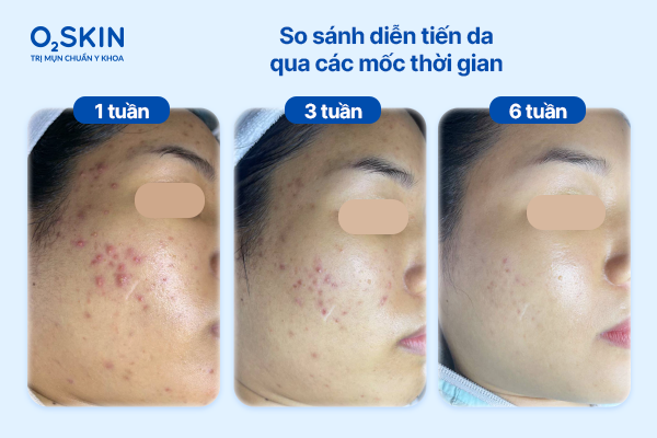 So sánh diện tiến trước – sau 6 tuần khôi phục nền da