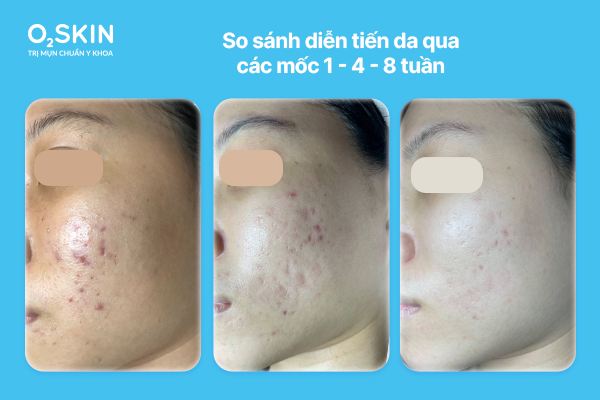 So sánh diễn tiến da qua các mốc 1 – 4 – 8 tuần