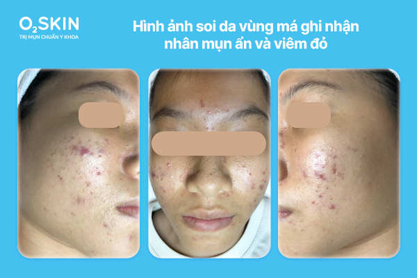 Hình ảnh soi da vùng má ghi nhận nhân mụn ẩn và viêm đỏ