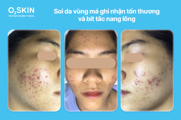 Soi da vùng má ghi nhận tổn thương và bít tắc nang lông