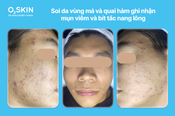 Soi da vùng má và quai hàm ghi nhận mụn viêm và bít tắc nang lông