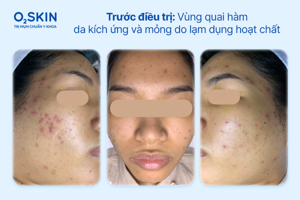 Soi da vùng má ghi nhận bít tắc và màng bảo vệ suy yếu