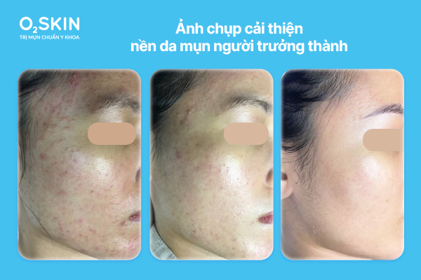 Ảnh chụp cải thiện nền da mụn người trưởng thành