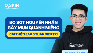Bỏ sót nguyên nhân gây mụn quanh miệng: Cải thiện sau 6 tuần điều trị