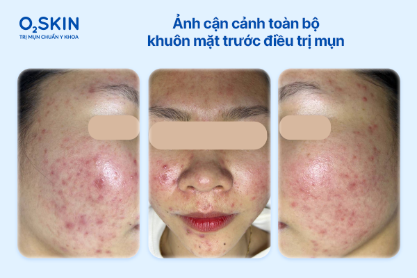 can-canh-khuon-mat-truoc-dieu-tri-mun-o2skin