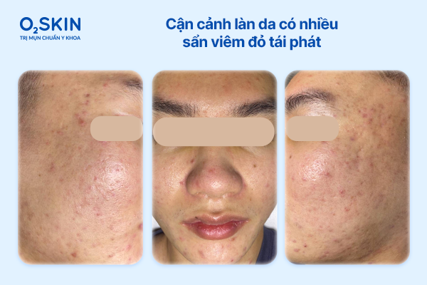 can-canh-lan-da-co-nhieu-san-viem-do-tai-phat-o2skin