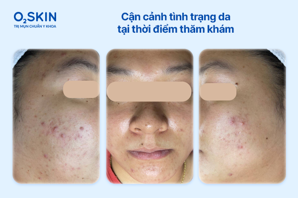 Cận cảnh tình trạng da tại thời điểm thăm khám can-canh-tinh-trang-da-tai-thoi-diem-tham-kham-o2skin
