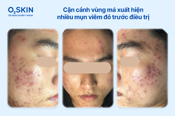 Cận cảnh vùng má xuất hiện nhiều mụn viêm đỏ trước điều trị