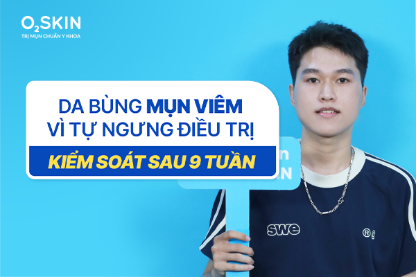 Da bùng mụn viêm vì tự ngưng điều trị: Kiểm soát sau 9 tuần