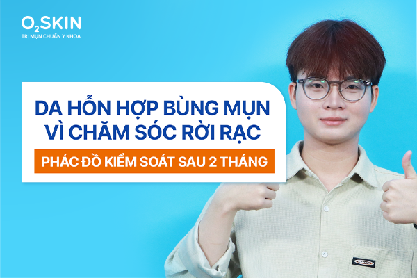 Da hỗn hợp bùng mụn vì chăm sóc rời rạc: Phác đồ kiểm soát sau 2 tháng