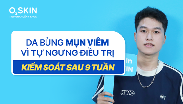 Da bùng mụn viêm vì tự ngưng điều trị: Kiểm soát sau 9 tuần