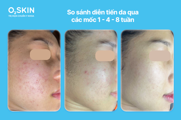 So sánh diễn tiến da qua các mốc 1 - 4 - 8 tuần