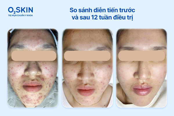 So sánh diễn tiến trước - sau 12 tuần điều trị